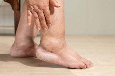 Can Tight Shoes Cause Edema?
